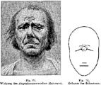Duval: S.253, Fig. 71 - 72, Augenbrauenrunzler.